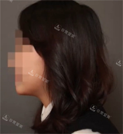 V脸打造后照片 V脸打造后照片