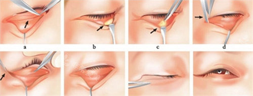 祛眼袋手术图
