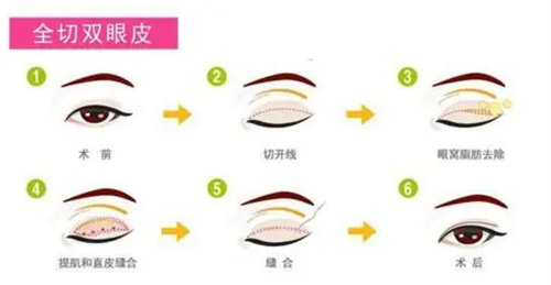 全切雙眼皮流程圖 全切雙眼皮流程圖