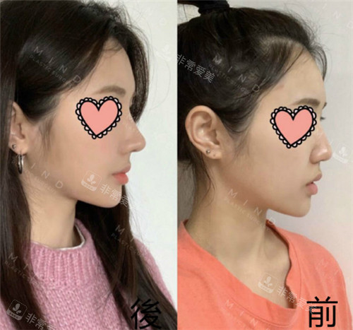 mind整形外科鼻整形對(duì)比照