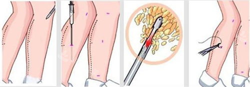 腿上吸脂圖 腿上吸脂圖