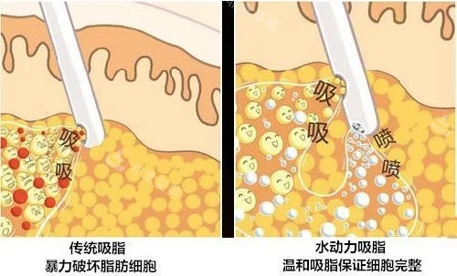吸脂形象圖 吸脂形象圖