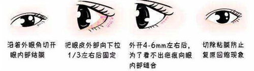 眼瞼下至操作圖 眼瞼下至操作圖