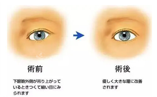 眼瞼下至前后對(duì)比圖 眼瞼下至前后對(duì)比圖