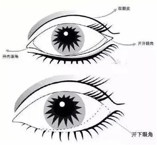 眼整形圖 眼整形圖