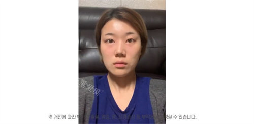 韩国GNG整形医院术前图 韩国GNG整形医院术前图