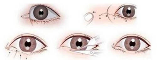 眼角手術(shù)動畫圖