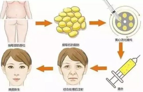 脂肪填充过程图 脂肪填充过程图