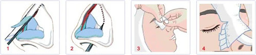 隆鼻过程示意图