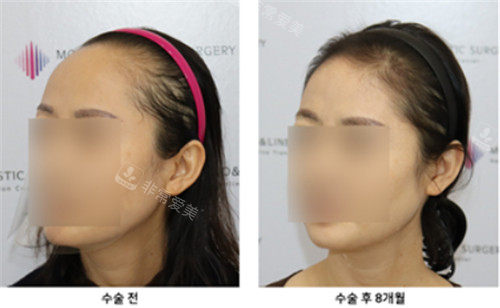 韩国毛莱茵整形做发际线手术图 韩国毛莱茵整形做发际线手术图