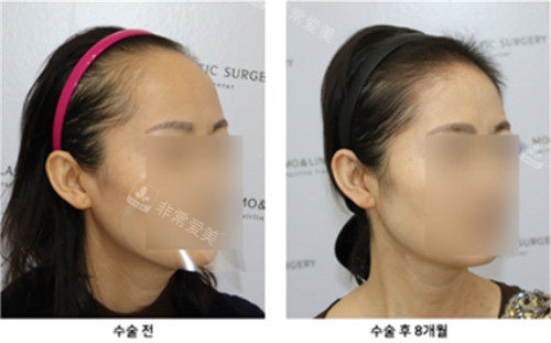 韩国毛莱茵毛发移植手术图片