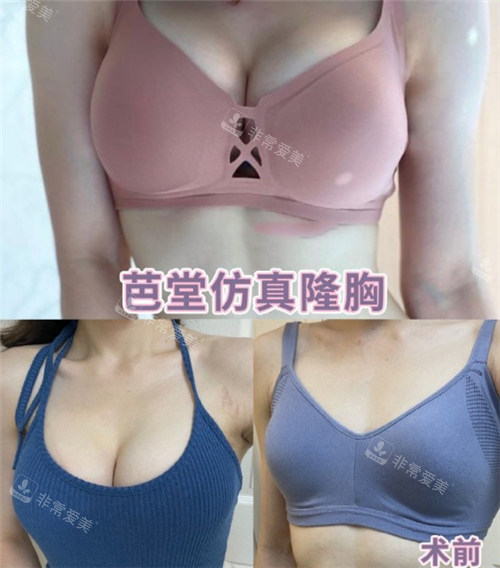 韩承范假体隆胸前后对比照 韩承范假体隆胸前后对比照