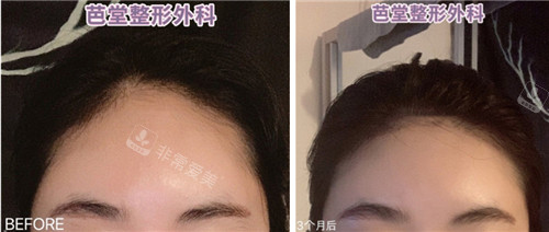 旻长焕额头缩小手术前后对比照 旻长焕额头缩小手术前后对比照