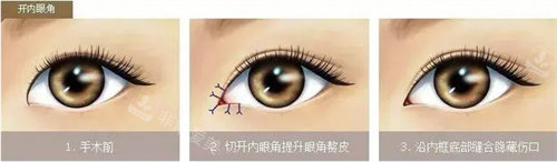 開內(nèi)眼角手術(shù)圖