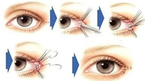 开眼角手术过程图