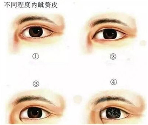 不同程度的內(nèi)眥贅皮