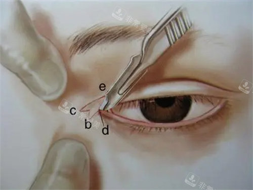 開眼角圖