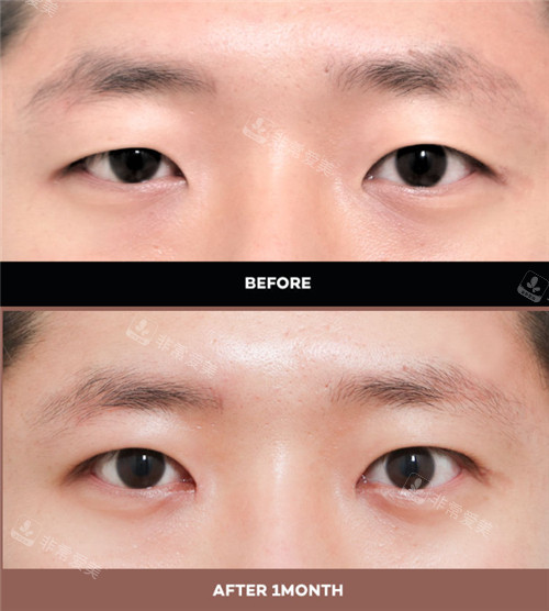 韩国都市整形外科眼部整形手术对比照