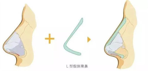 L型隆鼻假體動畫圖 L型隆鼻假體動畫圖