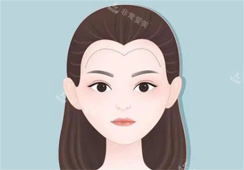 發(fā)際線種植術(shù)后對(duì)比圖
