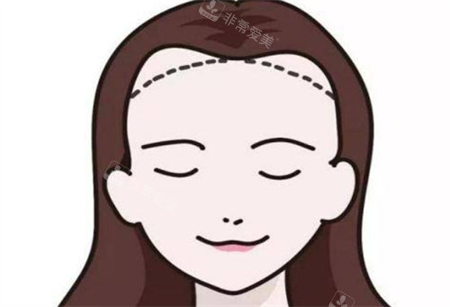發(fā)際線種植動(dòng)畫圖