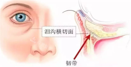 淚溝橫切面圖 淚溝橫切面圖