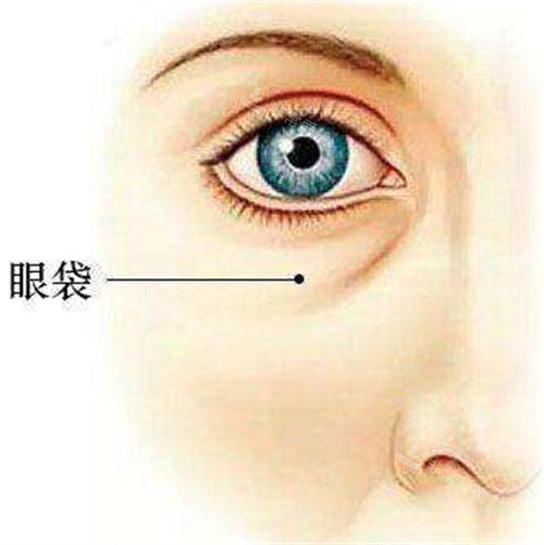 眼袋圖 眼袋圖