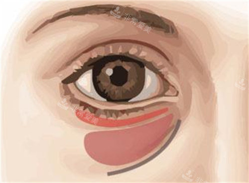 眼袋圖 眼袋圖