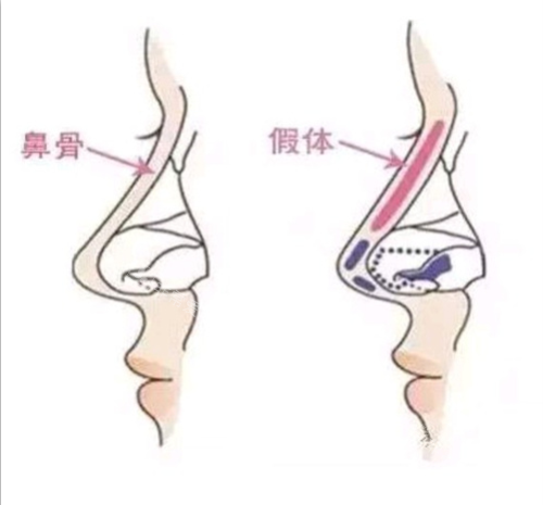 假体隆鼻示意图 假体隆鼻示意图