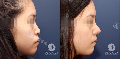 NANO整形凸嘴鼻整形手术对比图