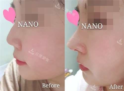 NANO整形驼峰鼻矫正手术对比图