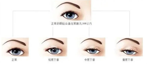 需要做眼部提肌的眼睛圖