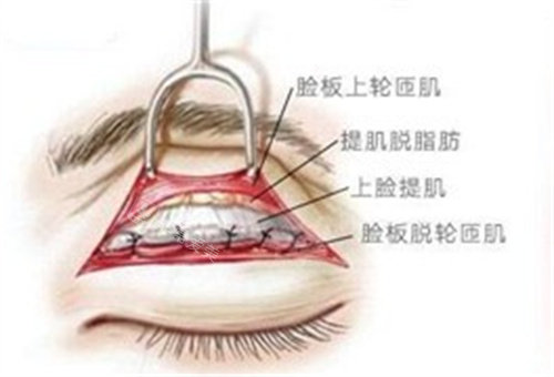 眼部提肌术图