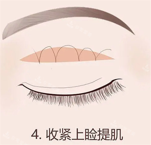 眼瞼提肌術(shù)圖