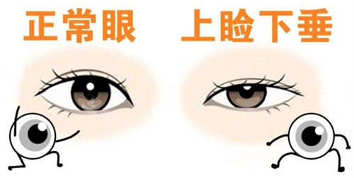 眼瞼下垂圖片