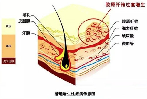 疤痕组织结构图