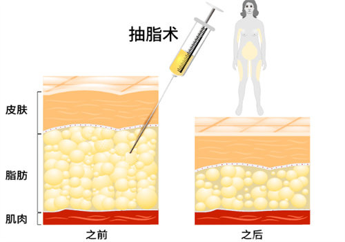 抽脂前后脂肪變化圖