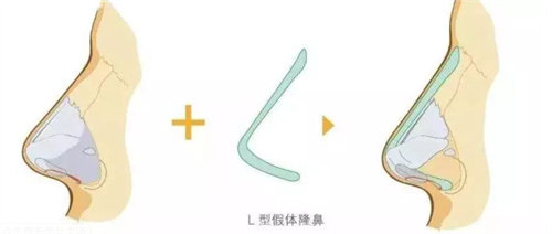 L型假體隆鼻展示圖 L型假體隆鼻展示圖