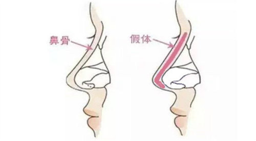 隆鼻假体放置位置展示图