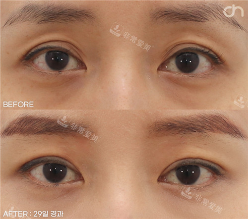 韩国喜可成形外科眼部脂肪填充对比图