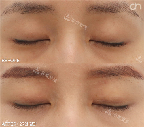 韩国喜可成形外科眼部脂肪填充疤痕情况
