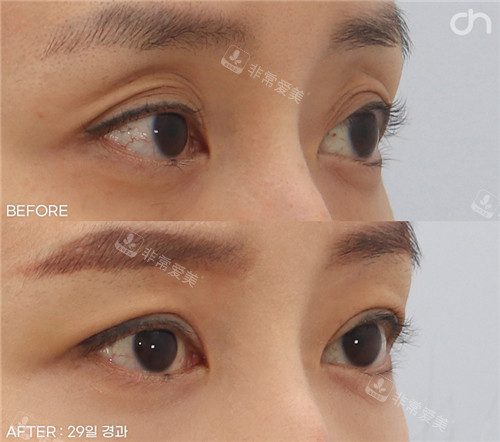 韩国喜可成形外科眼部脂肪填充侧面对比照