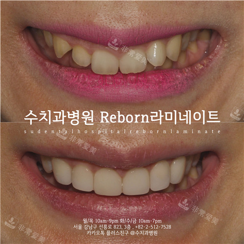 韩国SU牙科牙齿贴面对比