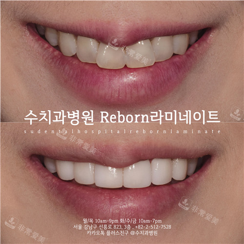 韩国SU牙科牙齿贴面对比照