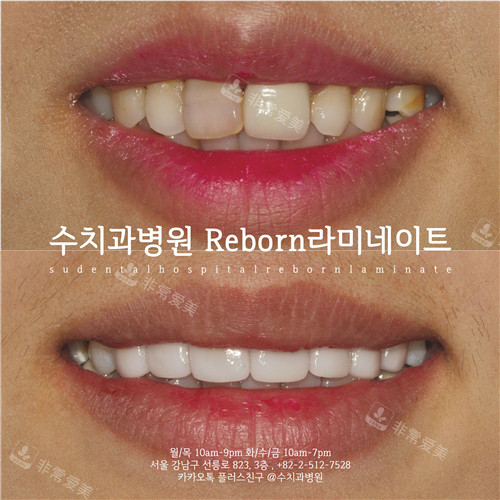 韩国SU牙科牙齿贴面前后图