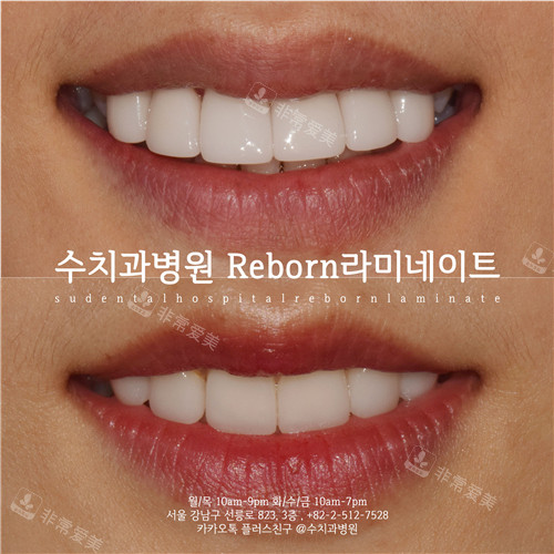 韩国SU牙科牙齿贴面修复对比照