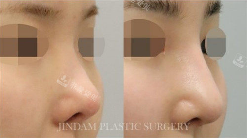 韩国真谈整形鼻尖上翘修复手术前后图片
