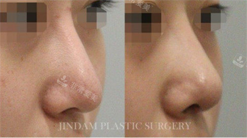 鼻子修复手术前后真实图片