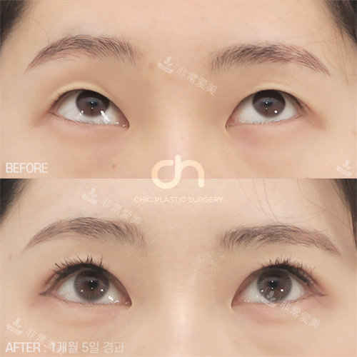 韓國喜可整形雙眼皮手術(shù)對(duì)比圖