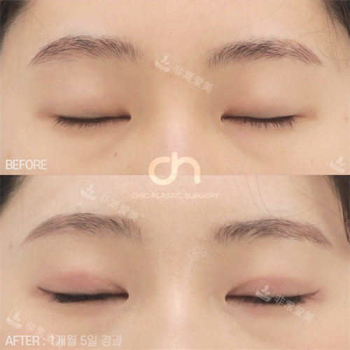 韓國喜可整形雙眼皮手術(shù)對(duì)比圖